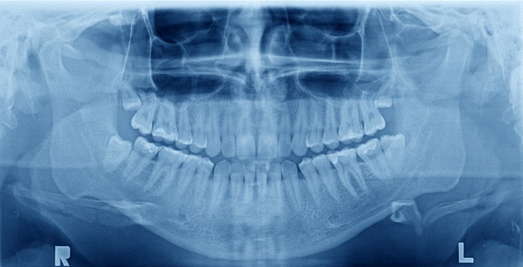 Panoramic x-ray image of teeth